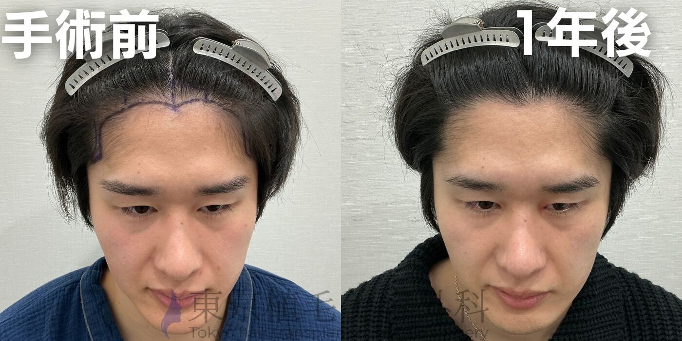 画像3894：✅20代男性 ✅眉毛植毛100株  ✅2024年8月手術 ✅術後6ヶ月
