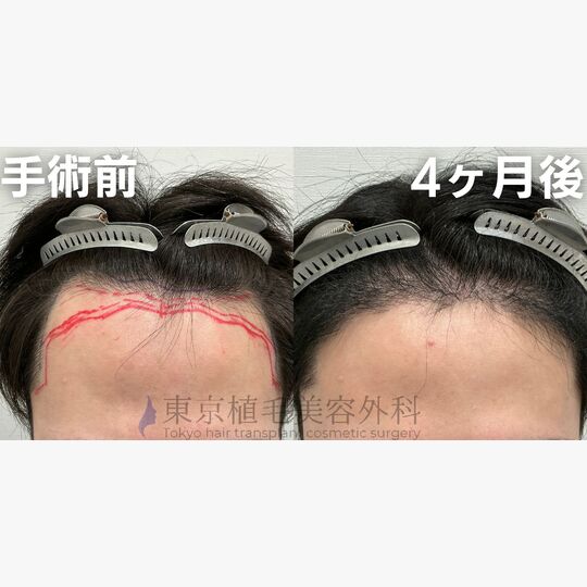 画像4006：✅20代 男性 ✅FUE2,000株 ✅生え際の手術 ✅4ヶ月後