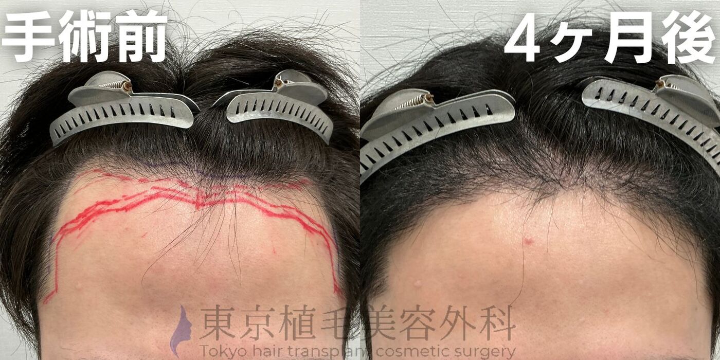 画像4006：✅20代男性 ✅眉毛植毛100株  ✅2024年8月手術 ✅術後6ヶ月