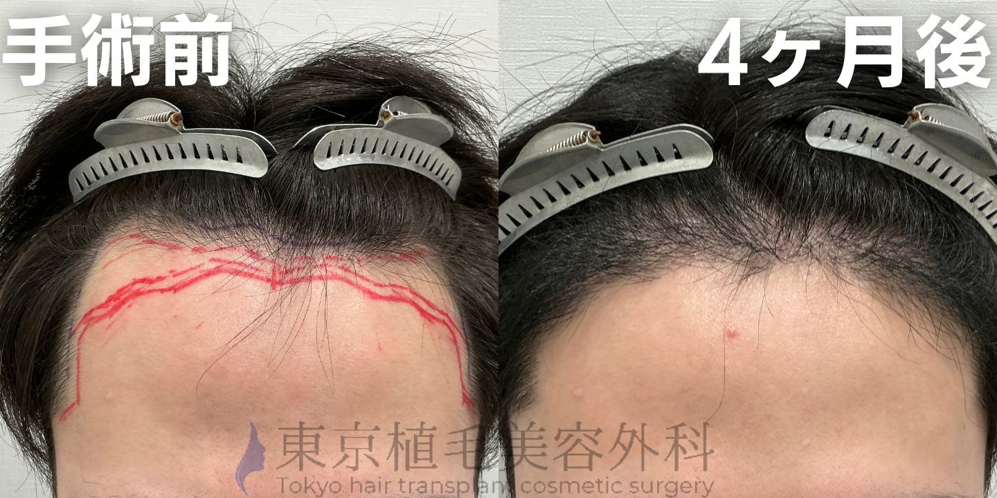 画像4006：✅20代男性 ✅眉毛植毛100株  ✅2024年8月手術 ✅術後6ヶ月
