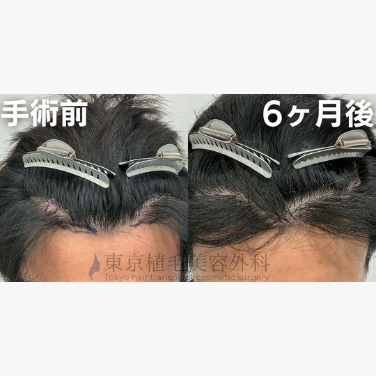 画像4009：✅30代 男性 ✅FUE1,000株 ✅生え際の手術 ✅手術6ヶ月後