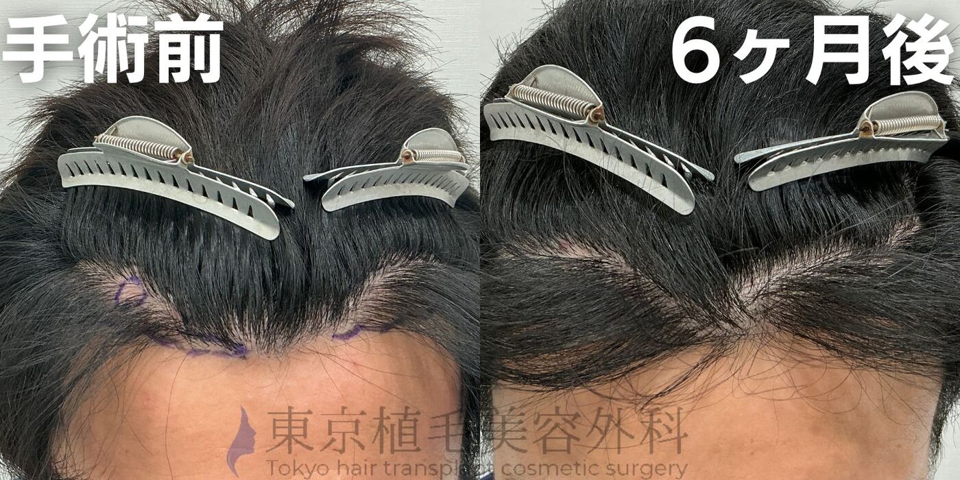 画像4009：✅20代男性 ✅眉毛植毛100株  ✅2024年8月手術 ✅術後6ヶ月