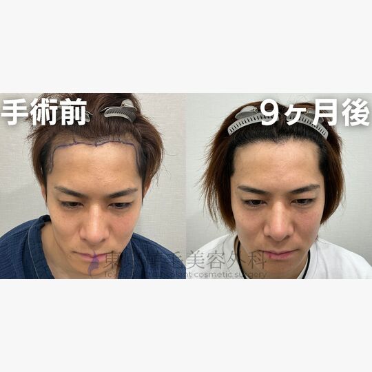 画像4012：✅30代 男性 ✅FUE1,900株 ✅生え際・頭頂部・こめかみの手術 ✅手術9ヶ月後