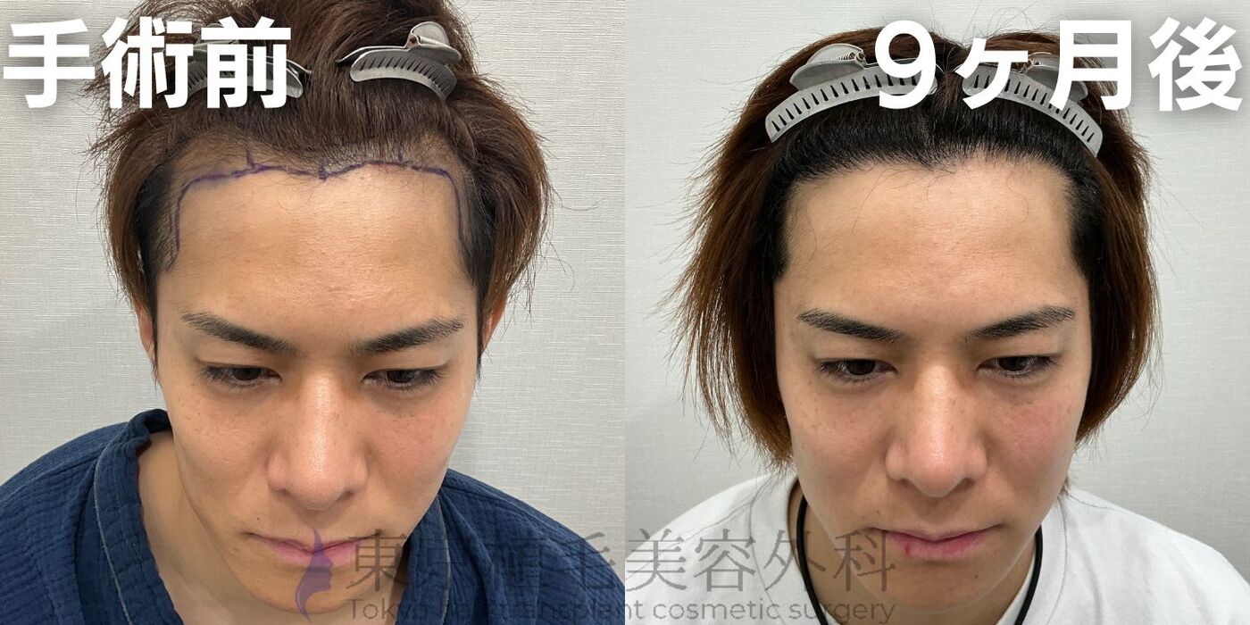 画像4012：✅20代男性 ✅眉毛植毛100株  ✅2024年8月手術 ✅術後6ヶ月