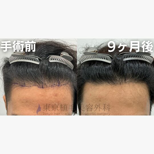 画像4048：✅40代 男性 ✅FUE1,500株 ✅生え際・前頭部の手術 ✅手術9ヶ月後