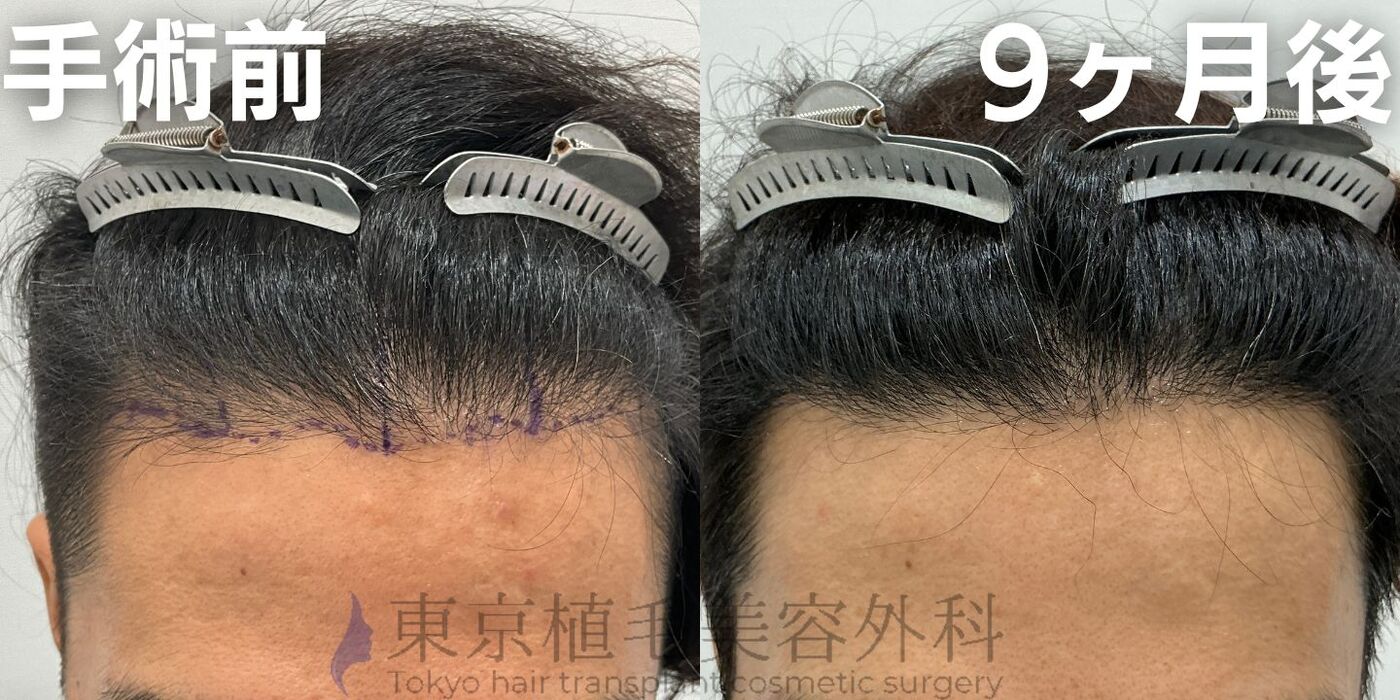 画像4048：✅20代男性 ✅眉毛植毛100株  ✅2024年8月手術 ✅術後6ヶ月