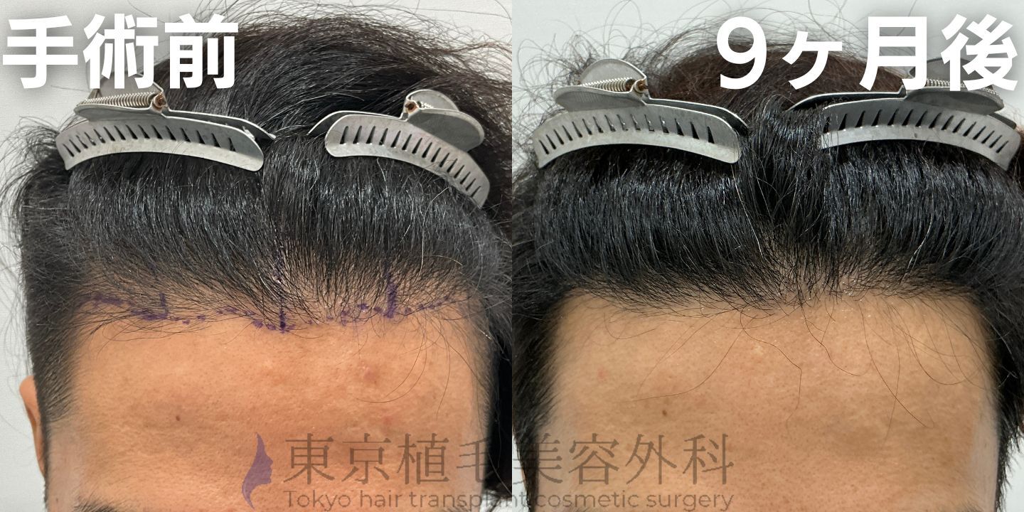 画像4048：✅20代男性 ✅眉毛植毛100株  ✅2024年8月手術 ✅術後6ヶ月