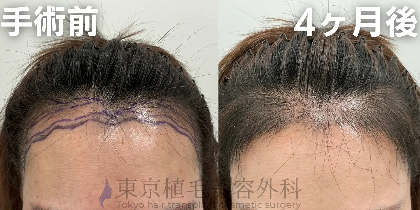 画像4069：✅40代 女性 ✅FUE2,100株 ✅生え際の手術 ✅手術4ヶ月後