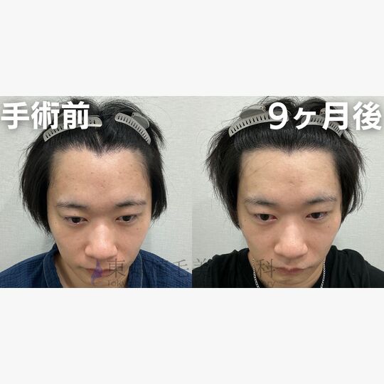 画像4072：✅30代 男性 ✅FUE1,300株 ✅生え際の手術 ✅手術9ヶ月後