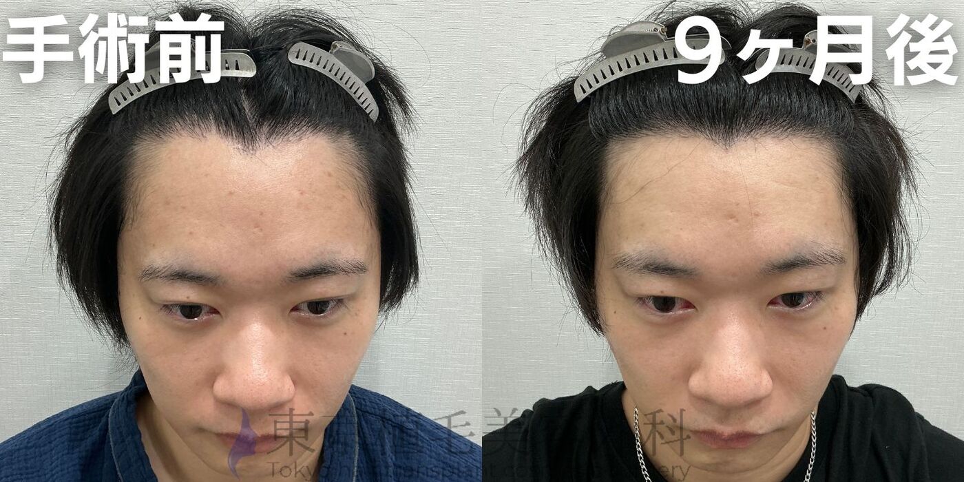 画像4072：✅20代男性 ✅眉毛植毛100株  ✅2024年8月手術 ✅術後6ヶ月