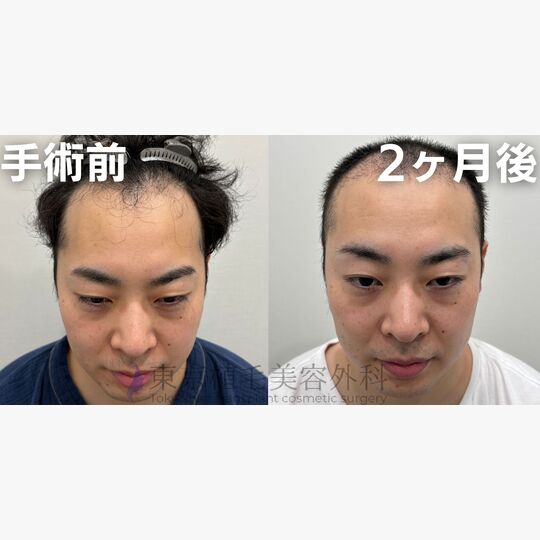 画像4073：✅30代 男性 ✅FUE3,647株 ✅生え際・頭頂部の手術 ✅手術2ヶ月後