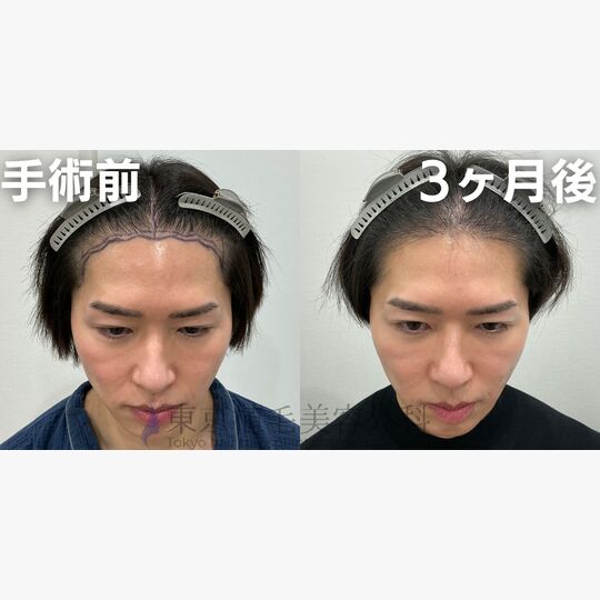 画像4074：✅40代 男性 ✅FUE2,528株 ✅生え際の手術 ✅3ヶ月後