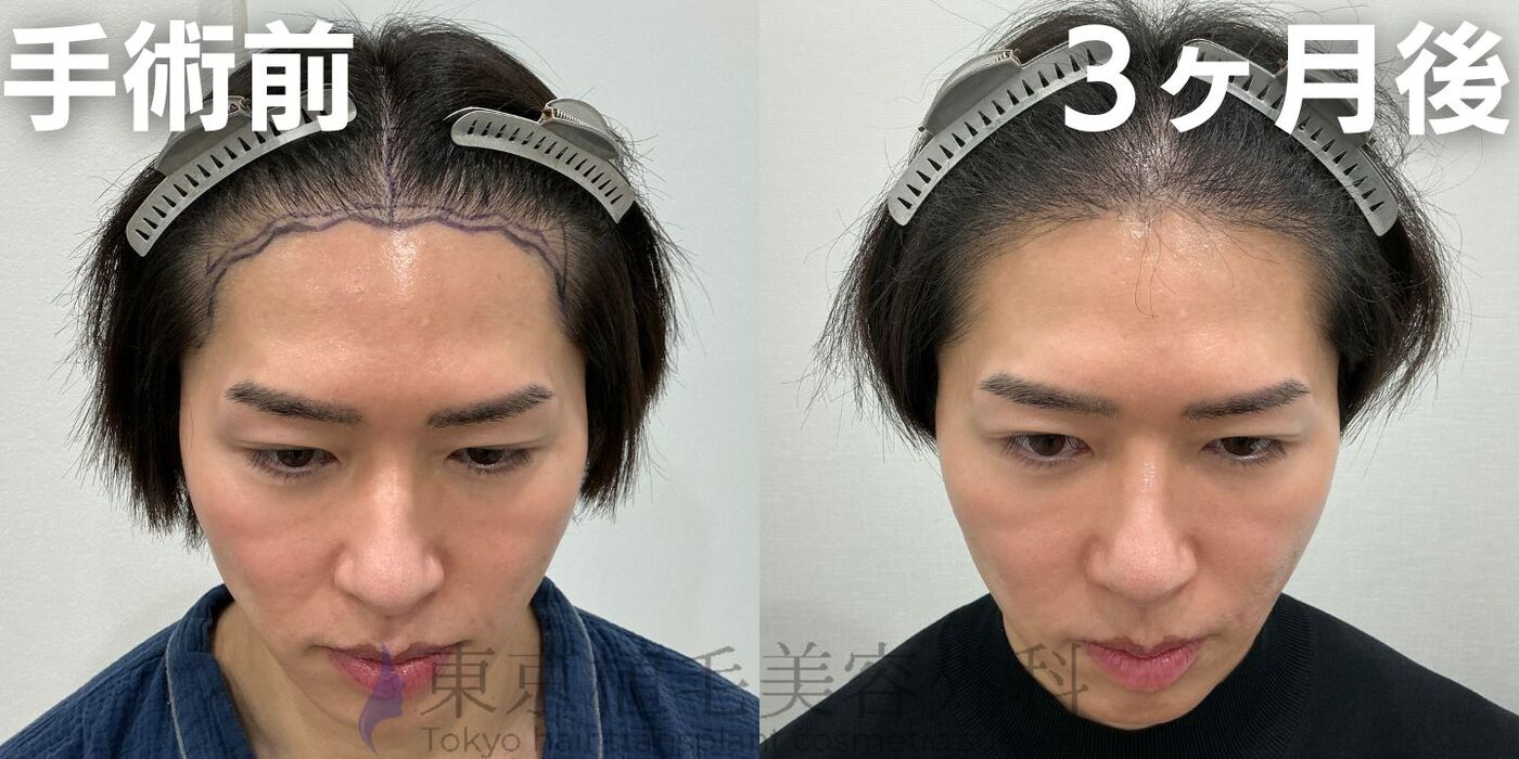 画像4074：✅20代男性 ✅眉毛植毛100株  ✅2024年8月手術 ✅術後6ヶ月