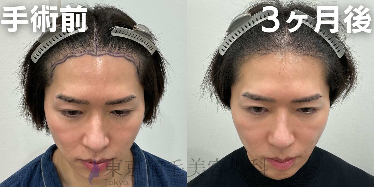 画像4074：✅20代男性 ✅眉毛植毛100株  ✅2024年8月手術 ✅術後6ヶ月