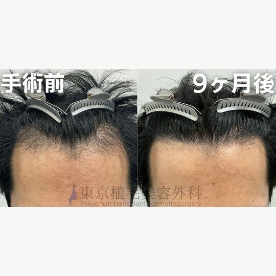 画像4080：✅30代 男性 ✅FUE1,500株 ✅生え際・こめかみの手術 ✅手術1年後