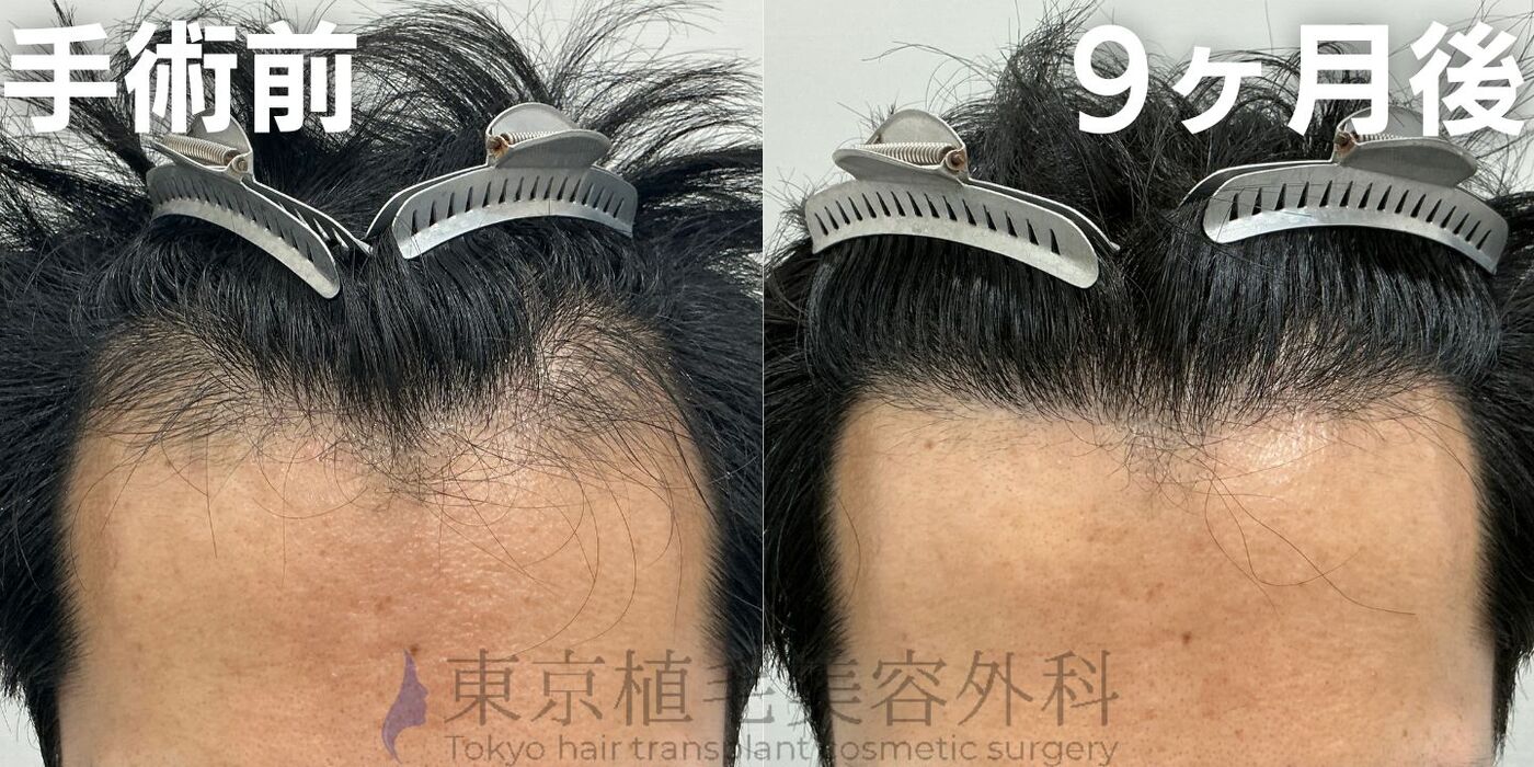 画像4080：✅20代男性 ✅眉毛植毛100株  ✅2024年8月手術 ✅術後6ヶ月