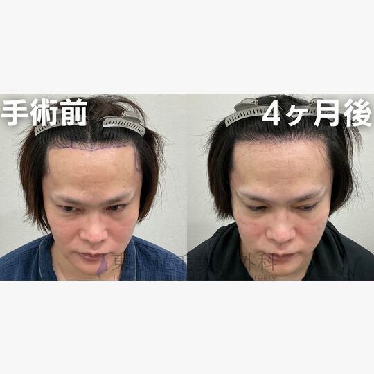 画像4081：✅30代 男性 ✅FUE1,300株 ✅生え際の手術 ✅4ヶ月後