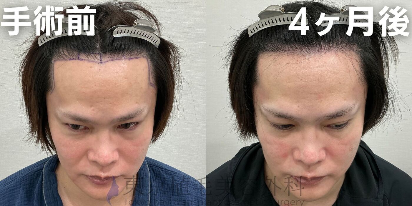 画像4081：✅20代男性 ✅眉毛植毛100株  ✅2024年8月手術 ✅術後6ヶ月