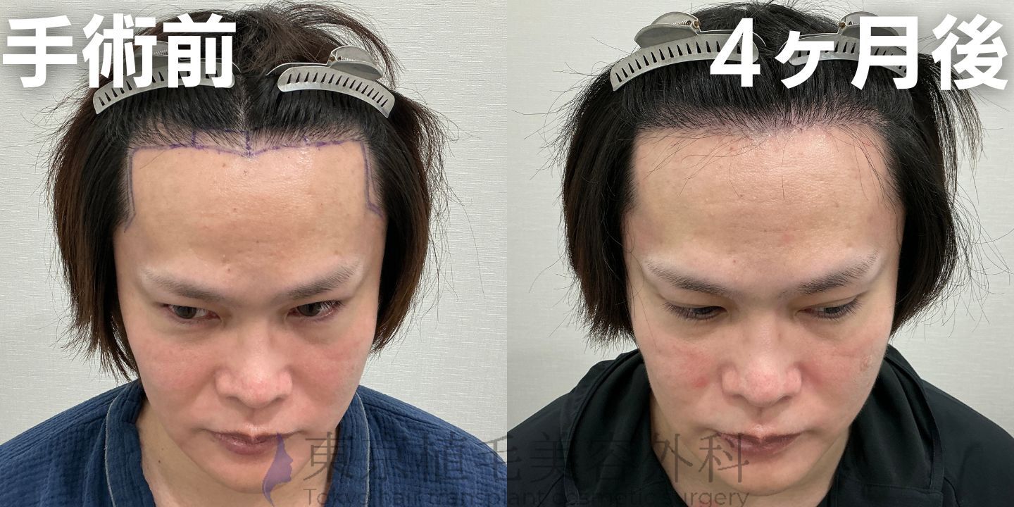 画像4081：✅20代男性 ✅眉毛植毛100株  ✅2024年8月手術 ✅術後6ヶ月