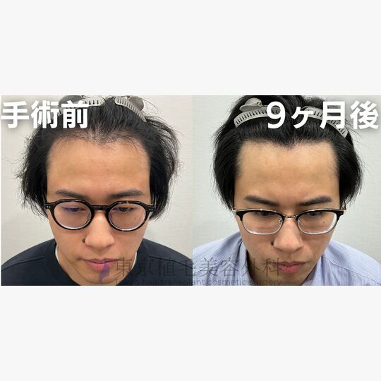 画像4111：✅30代 男性 ✅FUE2,500株 ✅生え際・前頭部・頭頂部の手術 ✅手術9ヶ月後