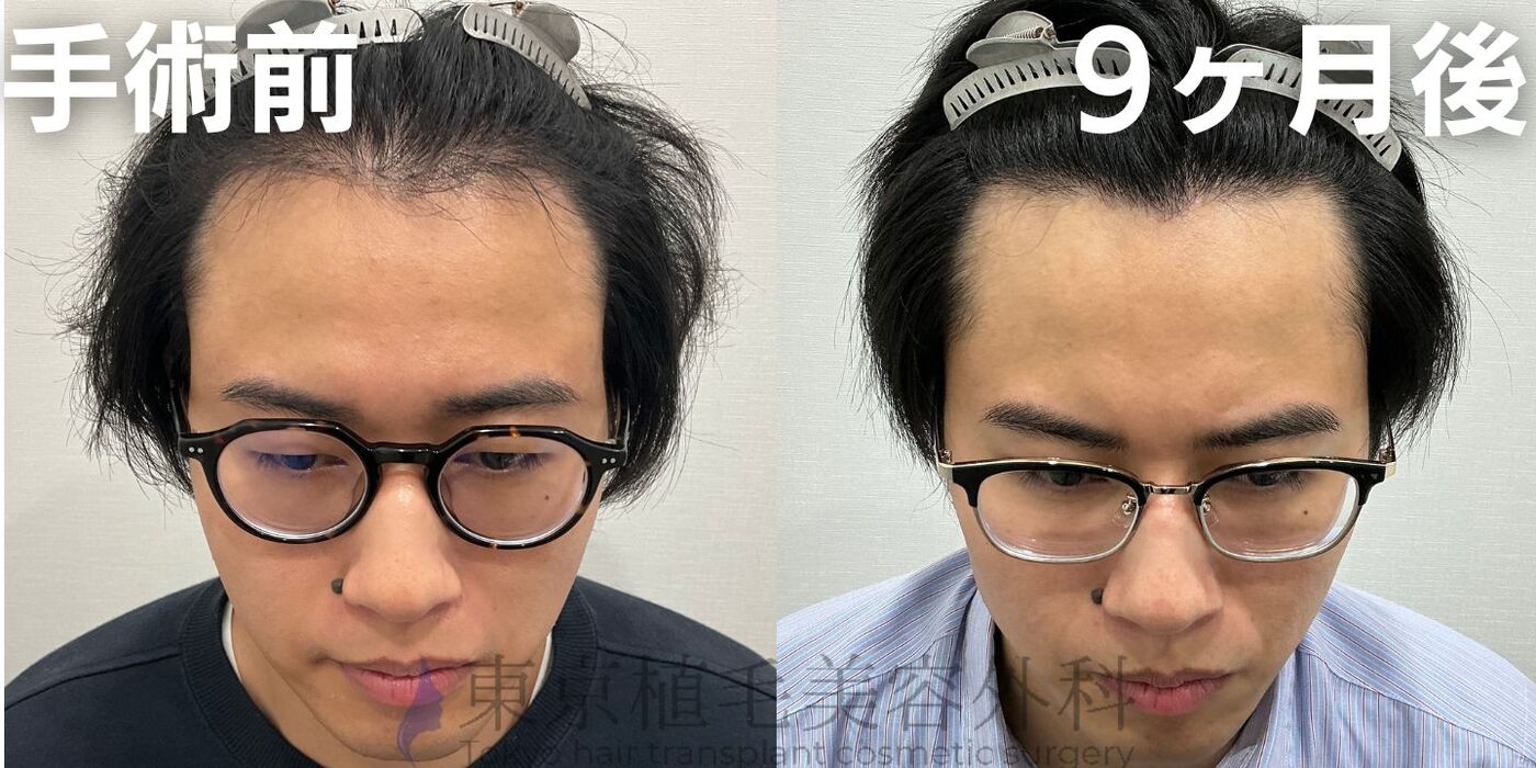 画像4111：✅20代男性 ✅眉毛植毛100株  ✅2024年8月手術 ✅術後6ヶ月
