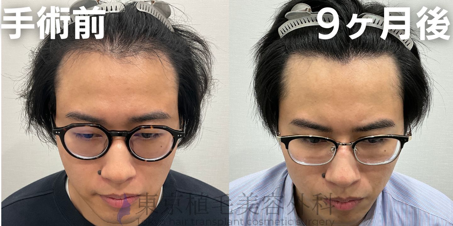 画像4111：✅20代男性 ✅眉毛植毛100株  ✅2024年8月手術 ✅術後6ヶ月