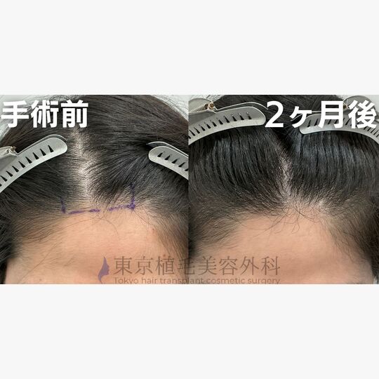 画像4137：✅20代 男性 ✅FUE1,021株 ✅生え際の手術 ✅手術2ヶ月後