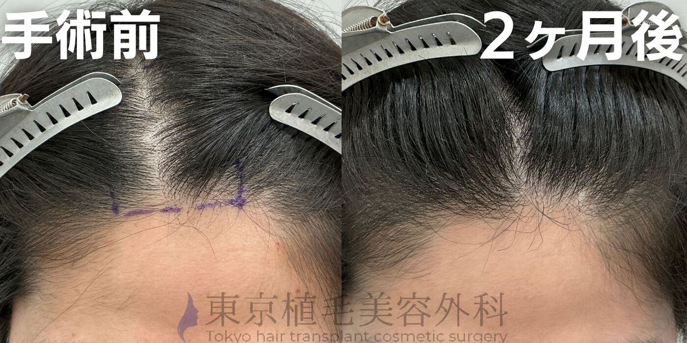 画像4137：✅20代男性 ✅眉毛植毛100株  ✅2024年8月手術 ✅術後6ヶ月