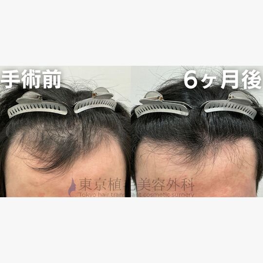 画像4140：✅20代 男性 ✅FUE2,615株 ✅生え際の手術 ✅6ヶ月後