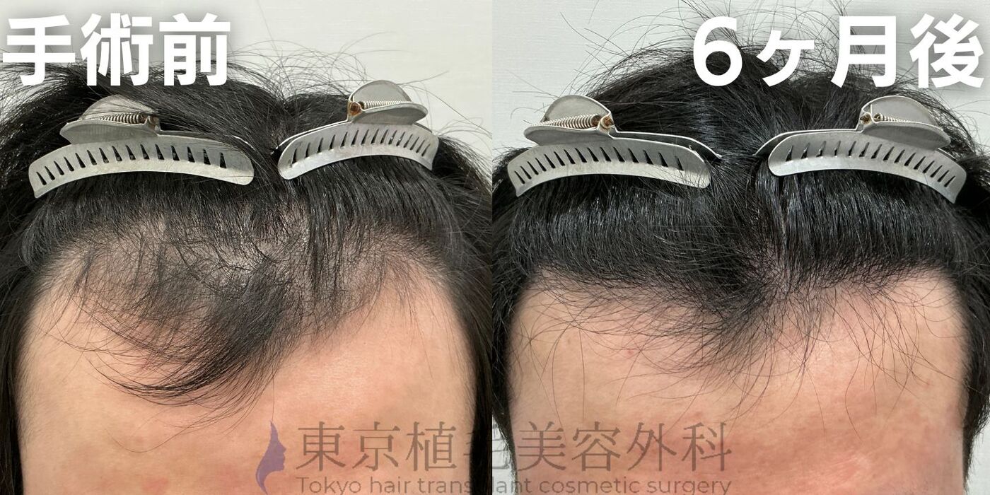 画像4140：✅20代男性 ✅眉毛植毛100株  ✅2024年8月手術 ✅術後6ヶ月