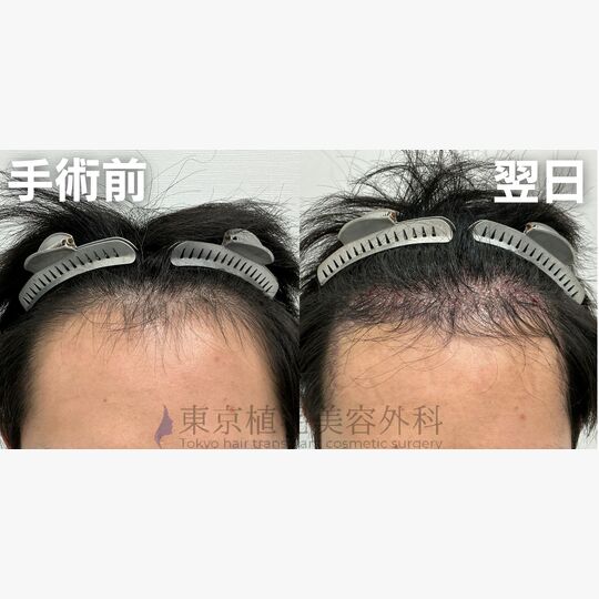 画像4206：✅20代 男性 ✅FUE1,833株 ✅生え際の手術 ✅手術翌日