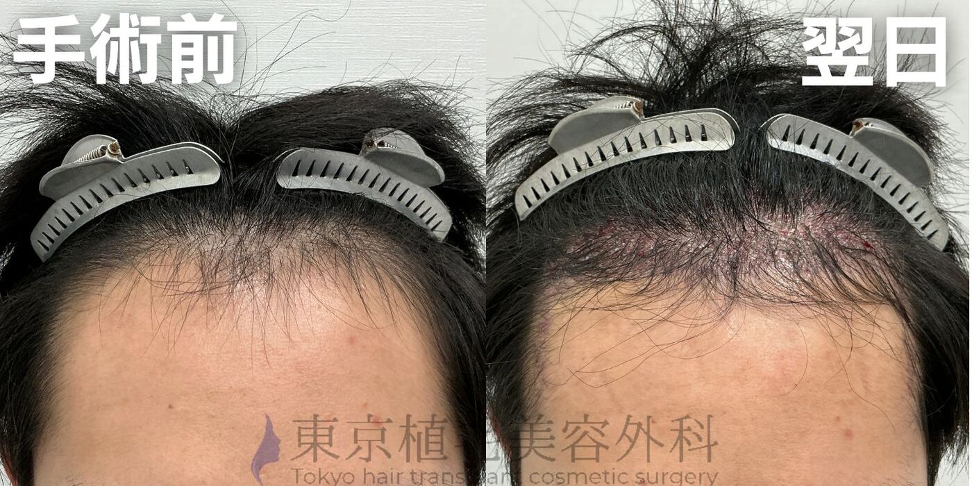 画像4206：✅20代男性 ✅眉毛植毛100株  ✅2024年8月手術 ✅術後6ヶ月