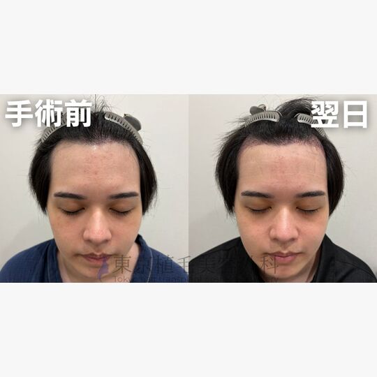 画像4228：✅20代 男性 ✅FUE2,208株 ✅生え際・前頭部・頭頂部の手術 ✅手術翌日