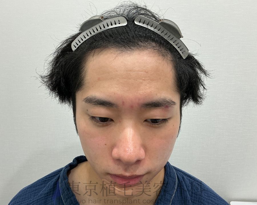 １枚 吉田様術前