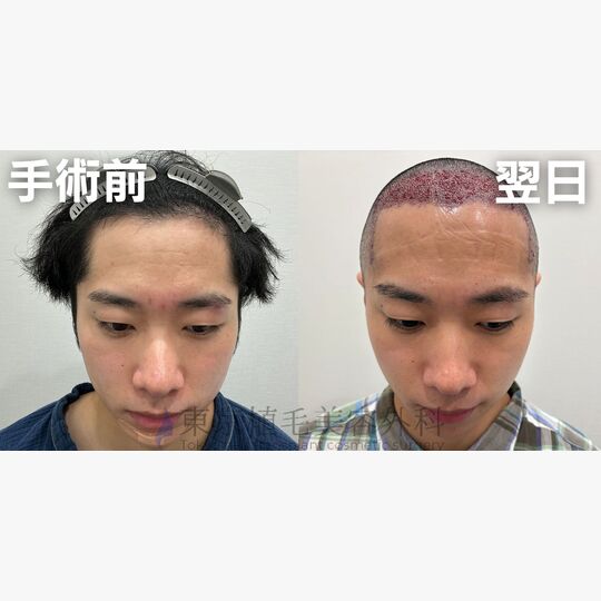 画像4239：✅20代 男性 ✅FUE1,979株 ✅生え際・前頭部の手術 ✅手術翌日