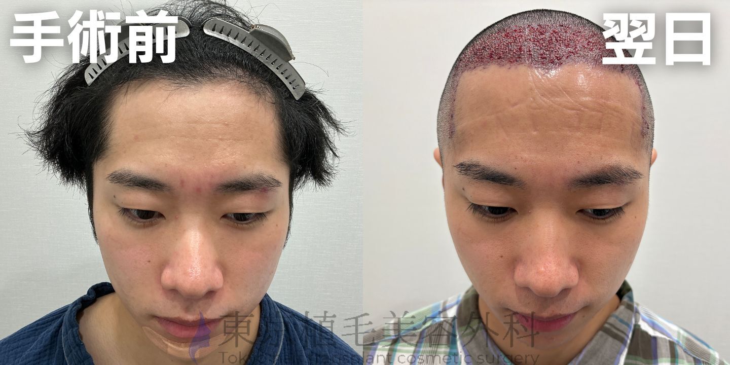 画像4239：✅20代男性 ✅眉毛植毛100株  ✅2024年8月手術 ✅術後6ヶ月