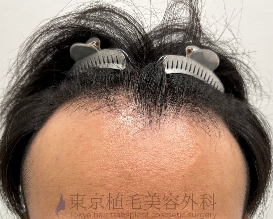 １枚 (3)　小曽根様術前