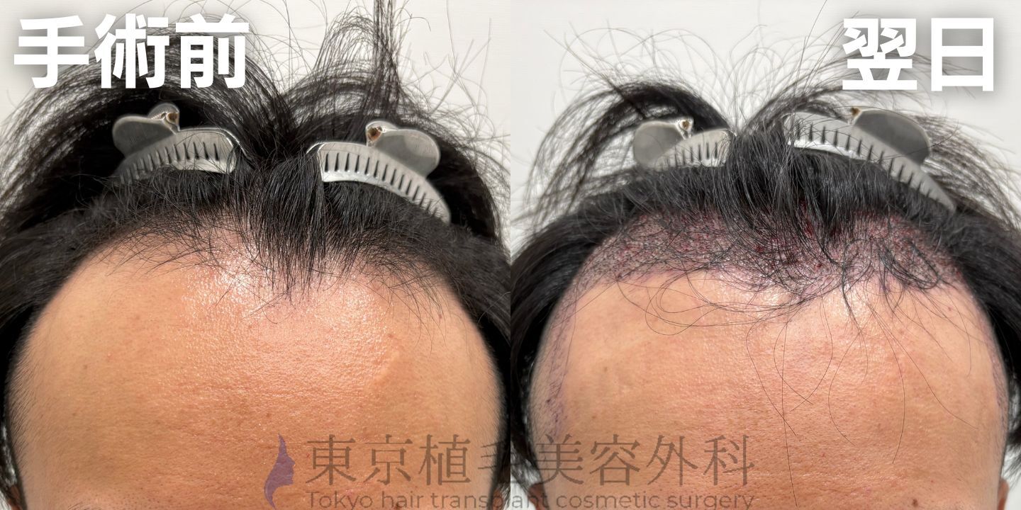 画像4247：✅20代男性 ✅眉毛植毛100株  ✅2024年8月手術 ✅術後6ヶ月