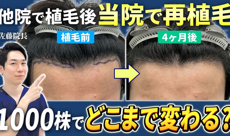 画像4305：東京植毛美容外科で生え際に1000株の植毛手術をした患者様の4・6ヶ月経過動画が公開されました