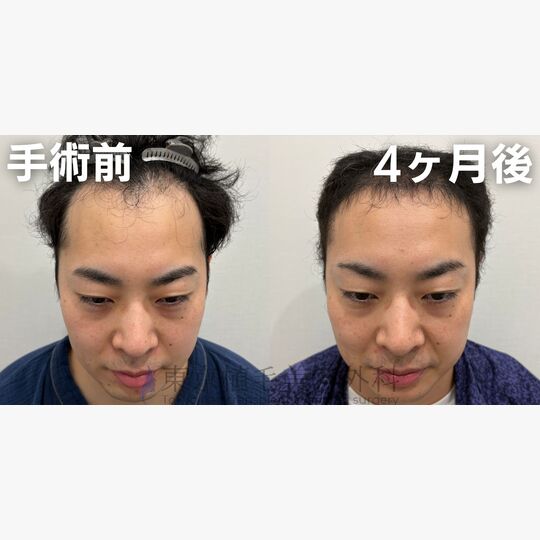 画像4311：✅30代 男性 ✅FUE3,647株 ✅生え際・頭頂部の手術 ✅手術4ヶ月後