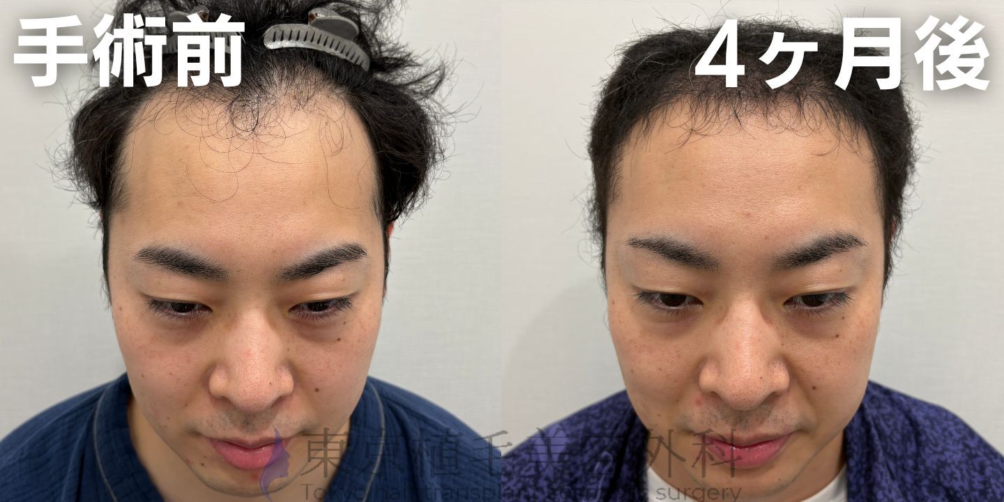 画像4311：✅20代男性 ✅眉毛植毛100株  ✅2024年8月手術 ✅術後6ヶ月