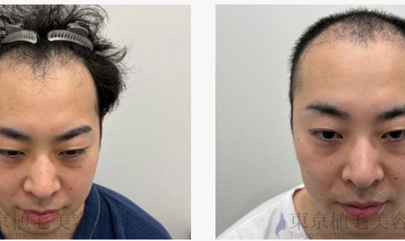 画像4313：当院で3600株の自毛植毛手術をされた30代男性の患者様の症例写真が更新されました