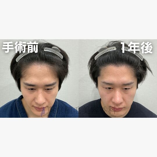 画像4353：✅20代 男性 ✅FUE1,423株 ✅生え際の手術 ✅手術1年後