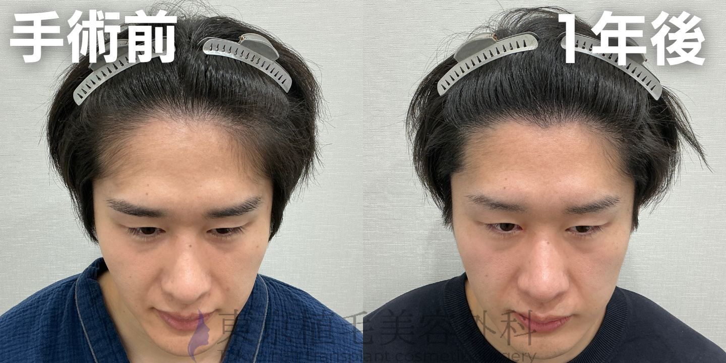 画像4353：✅20代男性 ✅眉毛植毛100株  ✅2024年8月手術 ✅術後6ヶ月