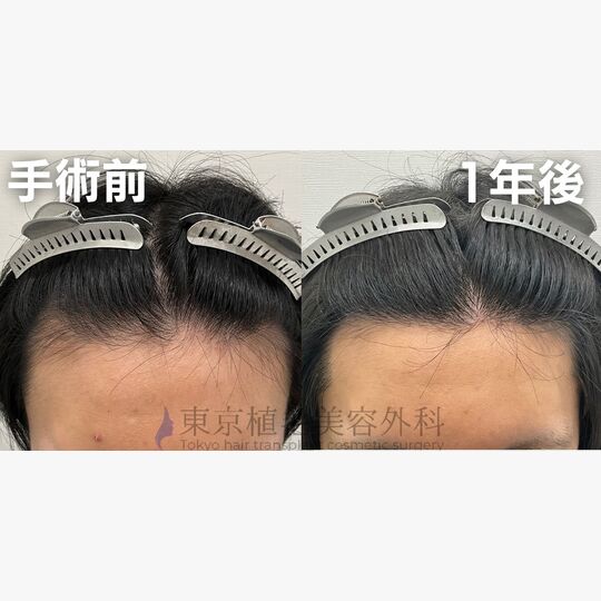 画像4354：✅30代 男性 ✅FUE1,000株 ✅生え際・こめかみの手術 ✅手術1年後