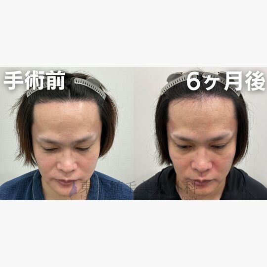 画像4357：✅30代 男性 ✅FUE1,300株 ✅生え際の手術 ✅6ヶ月後