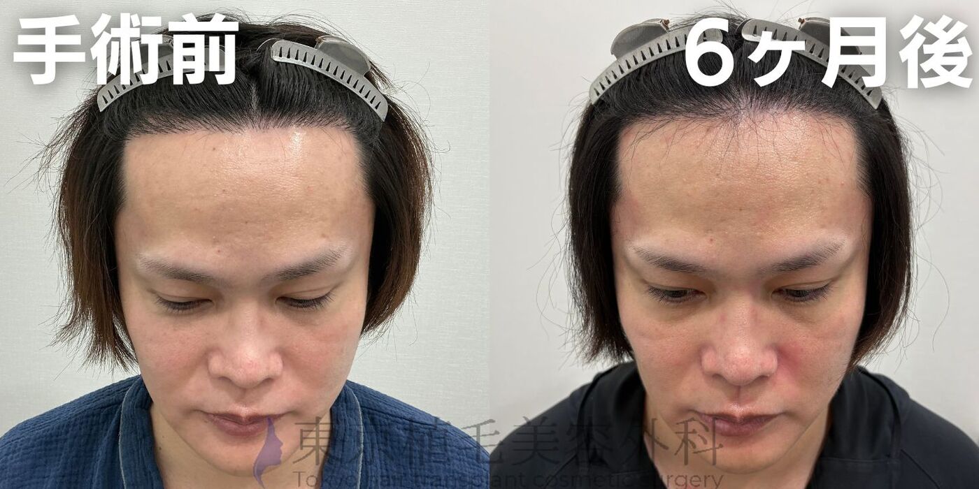 画像4357：✅20代男性 ✅眉毛植毛100株  ✅2024年8月手術 ✅術後6ヶ月