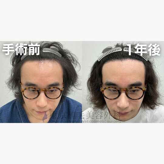 画像4358：✅30代 男性 ✅FUE1,400株 ✅生え際・こめかみの手術 ✅手術1年後