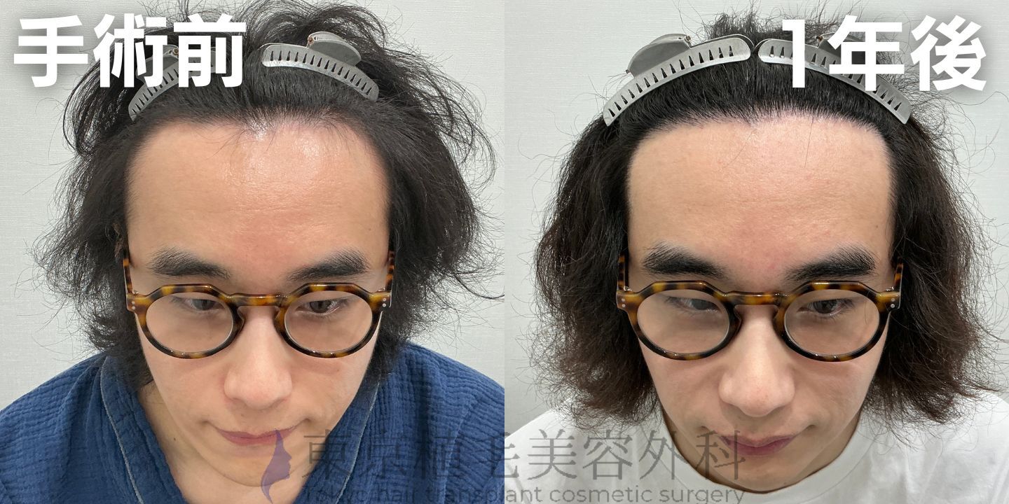 画像4358：✅20代男性 ✅眉毛植毛100株  ✅2024年8月手術 ✅術後6ヶ月