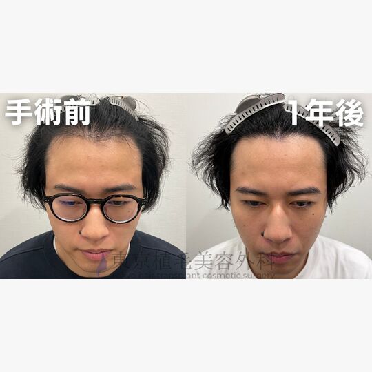 画像4359：✅30代 男性 ✅FUE2,500株 ✅生え際・前頭部・頭頂部の手術 ✅手術1年後